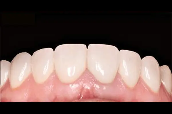 foto after veneer gigi