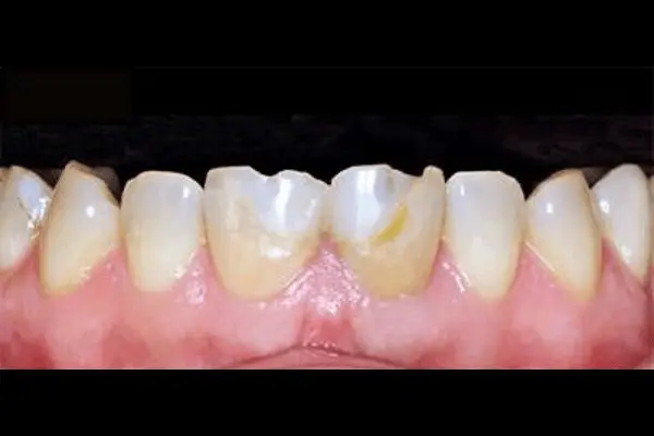 foto before veneer gigi