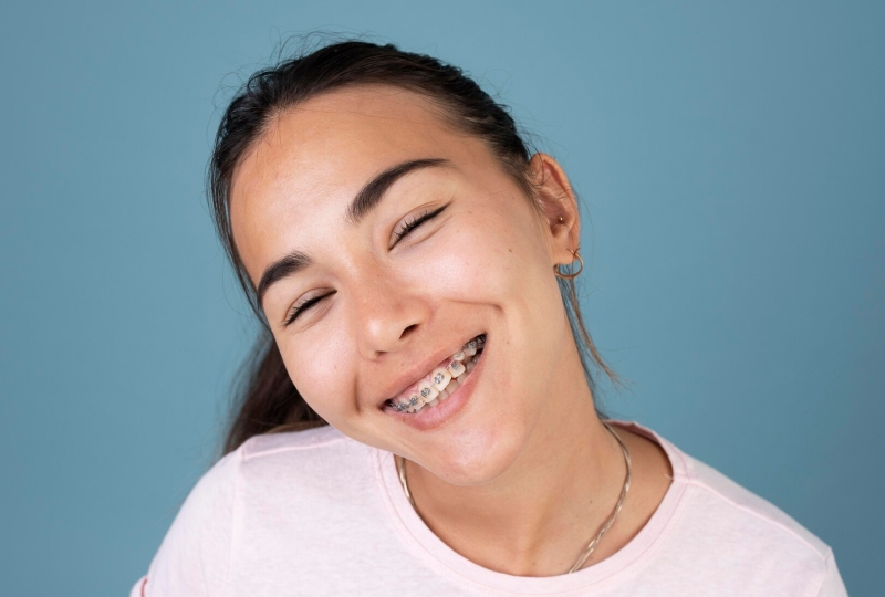 warna karet behel yang cantik untuk perempuan