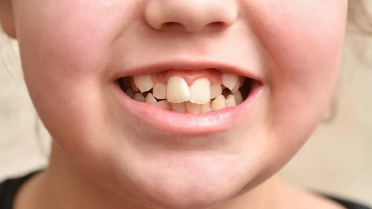 Penyebab gigi gingsul pada anak