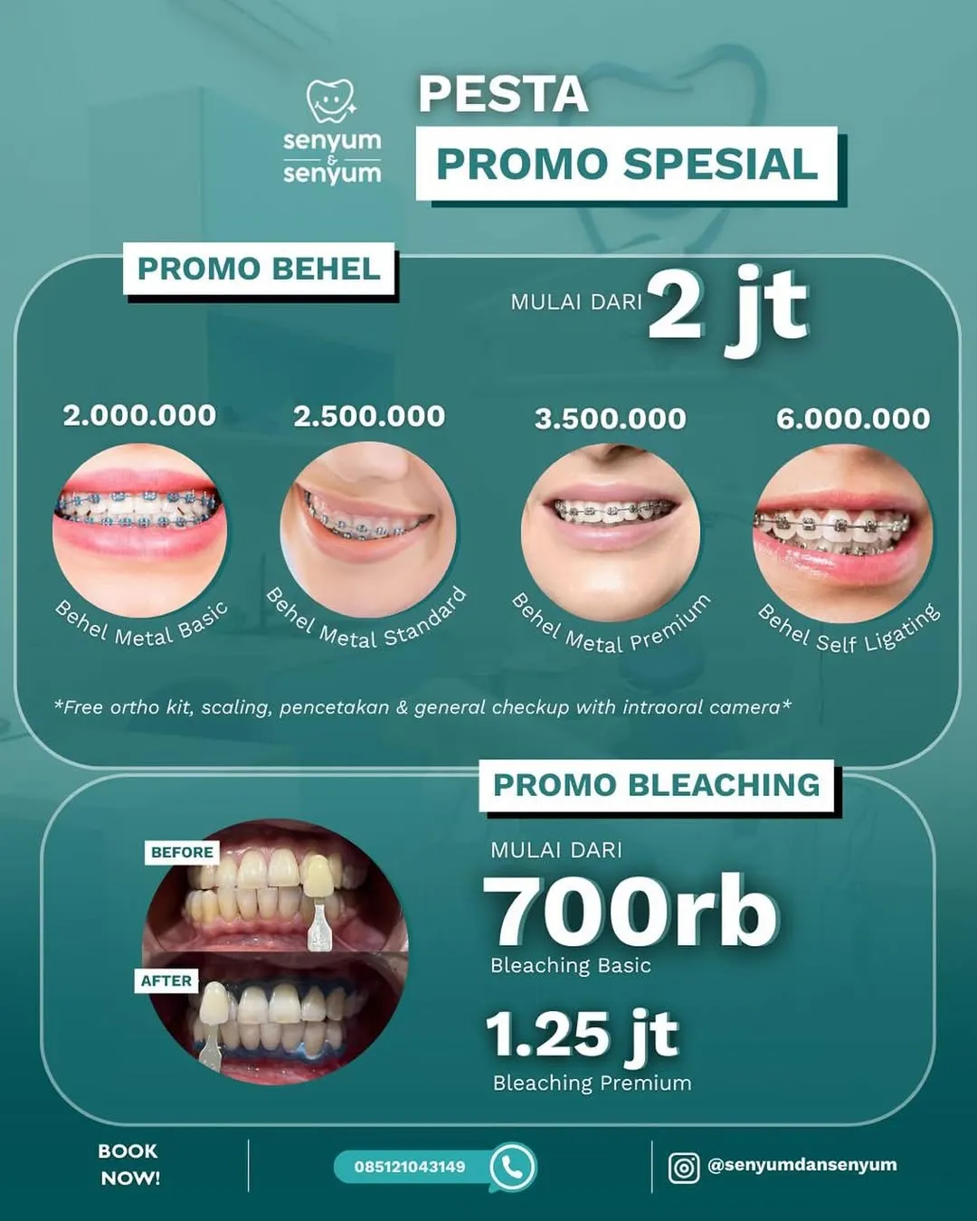promo behel dan bleaching gigi di klinik Senyum & Senyum Medan