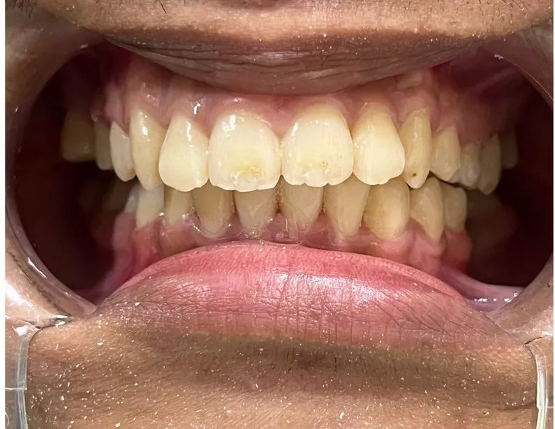 sebelum pasang behel gigi