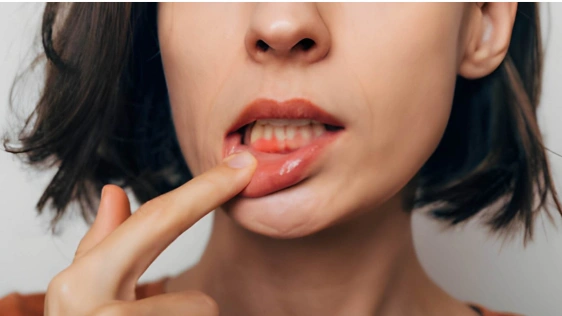 apa itu gingivitis