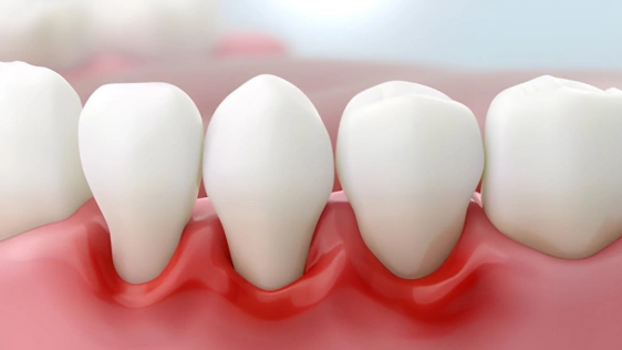 apa itu periodontitis